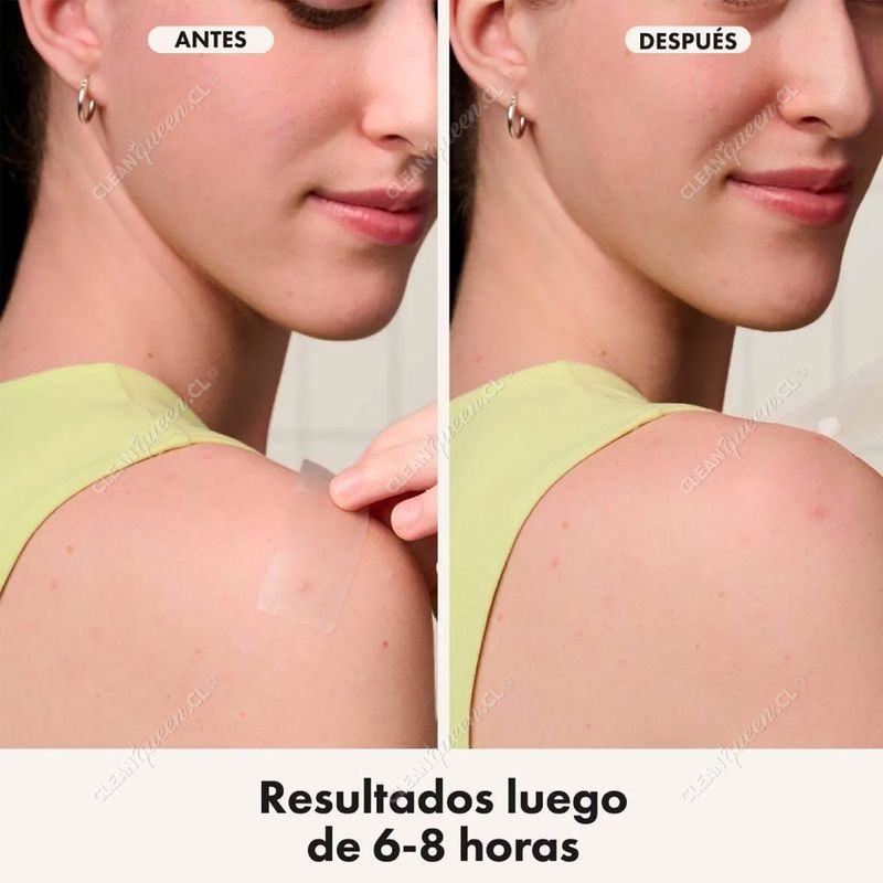 parche-antiacne-hero-mighty-patch-surface-10-un-6.jpg